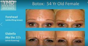 Before And After Botox Results By Dr. Yeilding's,Orlando