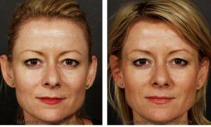Before And After Restylane, Botox Treatment By Dr. Rebecca Fitzgerald,M.D.,Beverly Hills