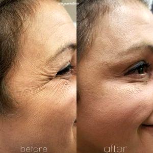 Before And After Treating Fine Lines And Wrinkles Around The Eyes. Patient Was Treated With Dysport At Regenerations Cosmetic Medicine,Knoxville