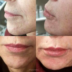 Before And Immediately After 2 Syringes Of Juvederm To The Lips And Lower Face At Regenerations Cosmetic Medicine,Knoxville