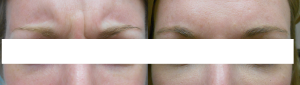 Botox 4weeks Post 15units By Michelle Boone, ARNP-BC,Orlando