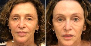 Botox And Belotero Combination Was Used For This Treatment By Dr. Andre Berger,M.D.,Beverly Hills