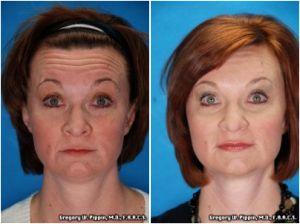 Botox And Juvederm Injections By Gregory W. Pippin, M.D., F.A.A.C.S.,New Orleans