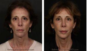 Botox And Sculptra Treatment By Dr. Rebecca Fitzgerald,M.D.,Beverly Hills