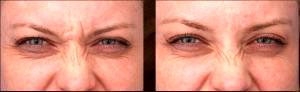Botox Before And After At Lasky Aesthetics Clinic, Beverly Hills