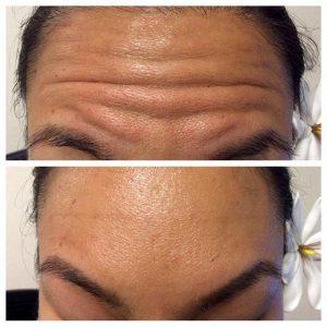 Botox Cosmetic Smooths Wrinkles On Forehead And Prevents Lines From Becoming Deeper At Pur Skin Clinic,Seattle