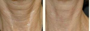 Botox For Neck Lines By Dr. Greenberg,M.D.,Orlando