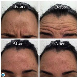 Botox For The Frown Lines, Forehead And Crows Feet At NewDermaMed,Toronto