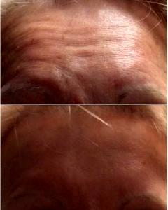 Botox Forehead In Toronto Before And After (2)