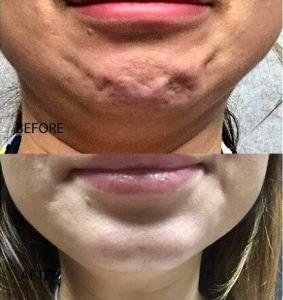 Botox In Chin To Help Reduce Orange Peel Effect By Ashley Pontenberg Our Nurse Practitioner,Orlando