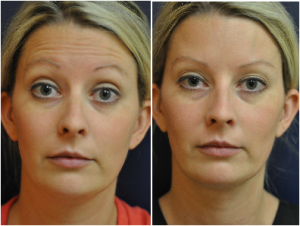 Botox Injection Forehead Wrinkles By Jennifer Reichel, MD,Seattle