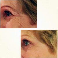 Botox Injection Treatment At Aesthetic Enhancements Plastic Surgery & Skin Care Center In Orlando
