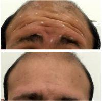 Botox Injections By Dr. Pat Pazmino, Fort Lauderdale Plastic Surgeon