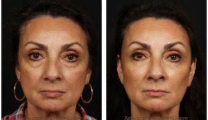 Botox Injections By Dr. Rebecca Fitzgerald,M.D.,Beverly Hills