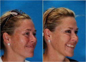 Botox Injections By Gregory W. Pippin, M.D., F.A.A.C.S.,New Orleans