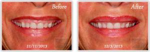 Botox Injections By Mary P. Lupo, M.D.,New Orleans