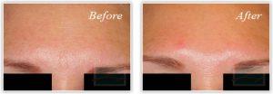 Botox Injections Frown Lines By Mary P. Lupo, M.D.,New Orleans