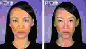 Botox Model Shown Here Demonstrates The Effects Of Treatment In The Corrugator Area (between The Eyebrows) By Dr. Edward J. Gross,M.D.,Orlando