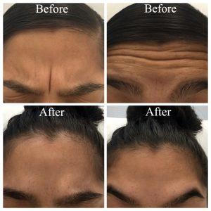 Botox Njections For The Frown Lines, Forehead And Crows Feet At NewDermaMed,Toronto