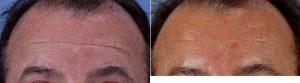 Botox To Forehead By Doctor Theda C. Kontis, MD, Baltimore Facial Plastic Surgeon