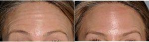 Botox To Reduce Forehead Wrinkles With Doctor Amit Bhrany, MD, Seattle Facial Plastic Surgeon
