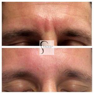 Botox To Smooth Glabella And Remove 11 Lines