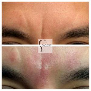 Botox To Smooth Glabella, Remove 11s With Dermal Fillers