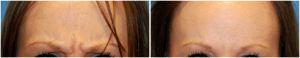 Botox To The Glabella, In Between The Eyes For The Eleven Lines ByDr. Philip Young MD, Seattle