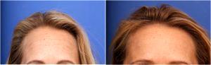 Botox Treatment At Lasky Aesthetics Clinic, Beverly Hills