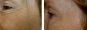 Botox Treatment By Dr. Greenberg,M.D.,Orlando