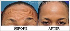 Botox Treatment By Ryan Greene, MD, PhD, FACS, Fort Lauderdale