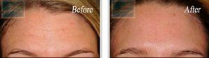 Botox Treatment For Forehead Wrinkles By Mary P. Lupo, M.D.,New Orleans