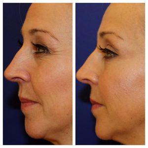 Botox Treatment With Pur Provider, Jill Kandora, Seattle