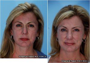 Botox Treatments To Her Glabella By Gregory W. Pippin, M.D., F.A.A.C.S.,New Orleans
