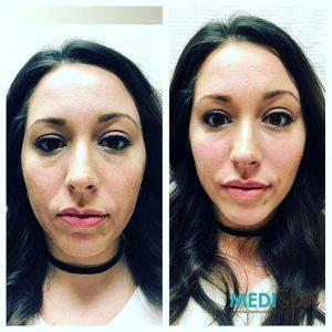 Botox Was Also Used To Achieve A Small Brow Lift By Brooke Bentley, FNP,Knoxville