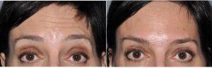 Botulinum Toxin Injection To Forehead With Dr. Amit Bhrany, MD, Seattle Facial Plastic Surgeon