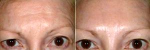 Brow Asymmetry By Dr. Mary P. Lupo, MD, New Orleans Dermatologist
