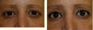 Brow Lift Treatment With Botox By Dr. Greenberg,M.D.,Orlando