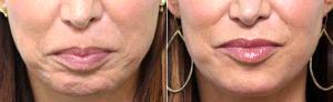 Chin Botox For Dimpling By Dr Amy K. Hsu, MD, Beverly Hills Facial Plastic Surgeon
