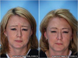 Correction Of The Deep Glabellar Crease (frown Line) By Gregory W. Pippin, M.D., F.A.A.C.S.,New Orleans