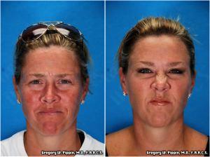 Correction Of The Facial Wrinkles With Botox By Gregory W. Pippin, M.D., F.A.A.C.S.,New Orleans