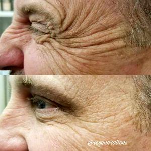 Crow's Feet Correction At Regenerations Cosmetic Medicine,Knoxville