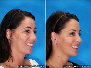 Crow's Feet Correction With Botox By Gregory W. Pippin, M.D., F.A.A.C.S.,New Orleans