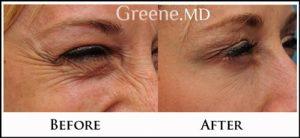 Crows Feet Correction With Botox By Ryan Greene, MD, PhD, FACS, Fort Lauderdale