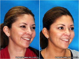Crows Feet Correction With Botox Cosmetic By Gregory W. Pippin, M.D., F.A.A.C.S.,New Orleans
