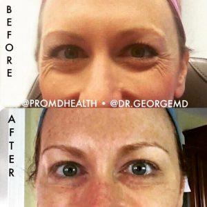Crow's Feet Treatment With Botox By George Gavrila, MD,Baltimore