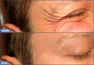 Crow's Feet Wrinkles Correction By Francis R Palmer III, M.D., F.A.C.S.,Beverly Hills