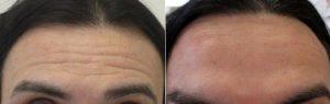 Doctor Benjamin Barankin, MD, FRCPC, Toronto Dermatologic Surgeon - 47 Year Old Male Treated For Forehead Wrinkles With Botox