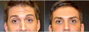 Dr Dean P. Kane, MD, FACS, Baltimore Plastic Surgeon - 44 Year Old Man Treated With Botox