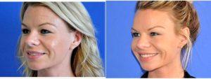 Dr Karan Dhir, MD, Beverly Hills Facial Plastic Surgeon - 27 Year Old Woman Treated With Botox